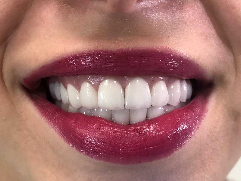 @euro-dental-centar-sarajevo-nasi-radovi-poslije-Aa1
