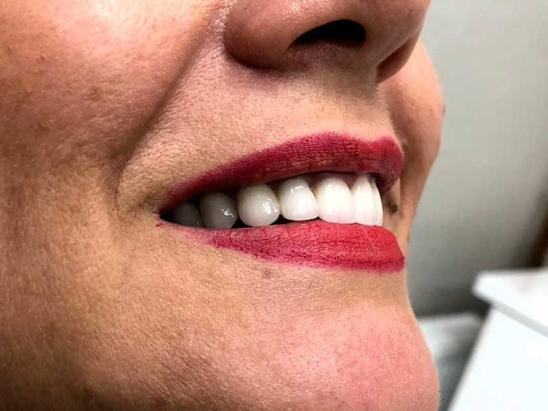 @euro-dental-centar-sarajevo-nasi-radovi-poslije-B