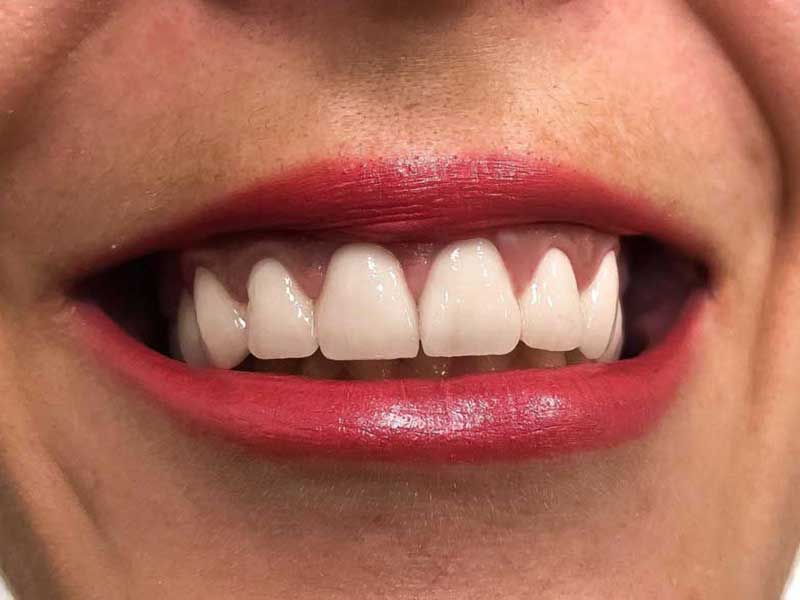 @euro-dental-centar-sarajevo-nasi-radovi-poslije-C