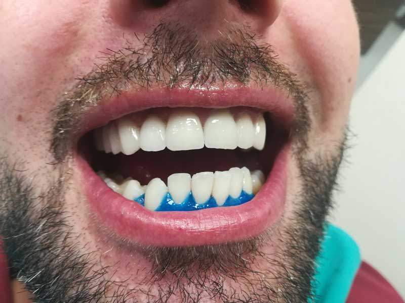 @euro-dental-centar-sarajevo-nasi-radovi-poslije-D