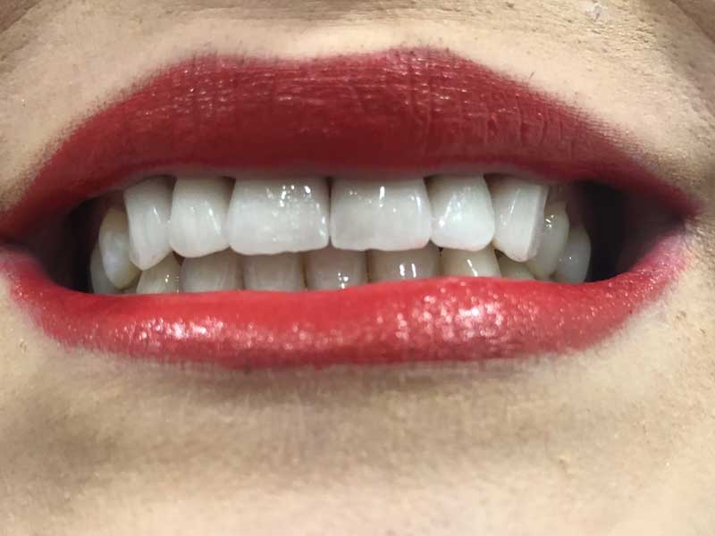 @euro-dental-centar-sarajevo-nasi-radovi-poslije-G