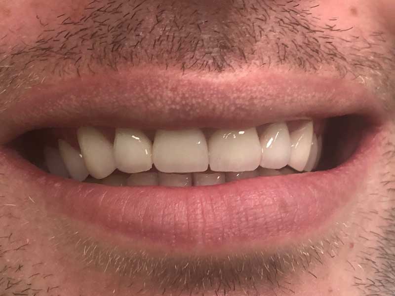 @euro-dental-centar-sarajevo-nasi-radovi-poslije-H
