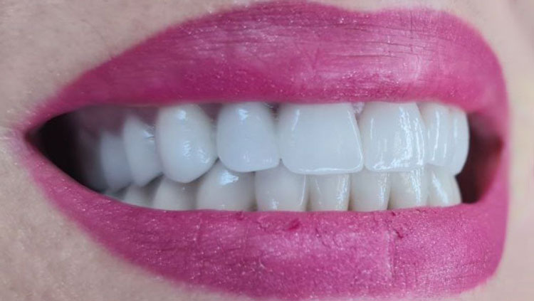 euro-dental-centar-sarajevo-navlake-cirkon-rad2