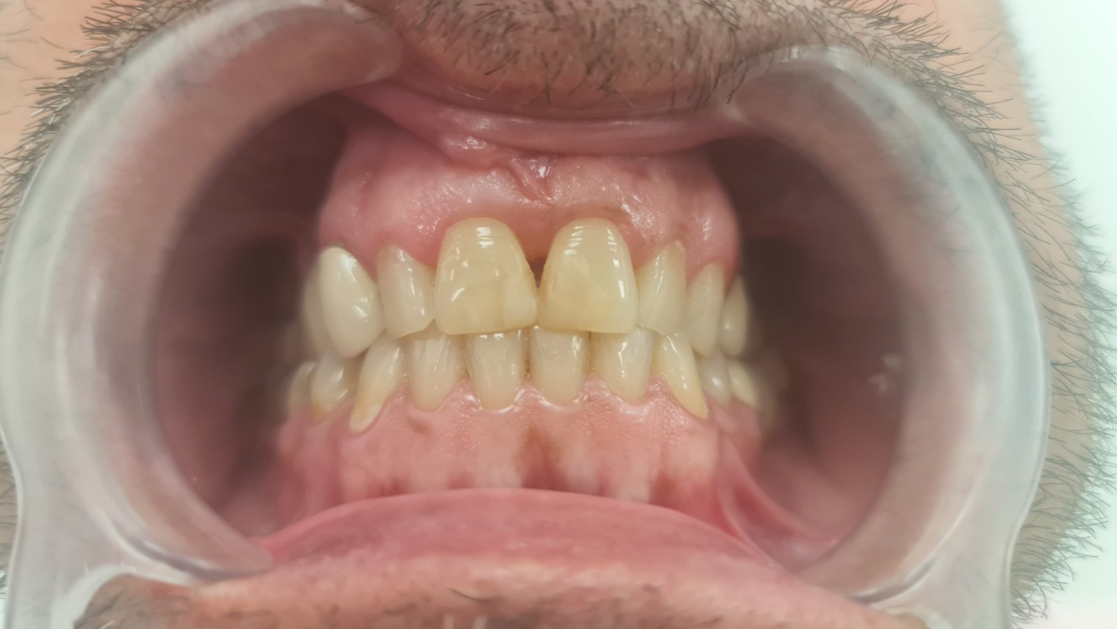 prije-eurodental-nn1